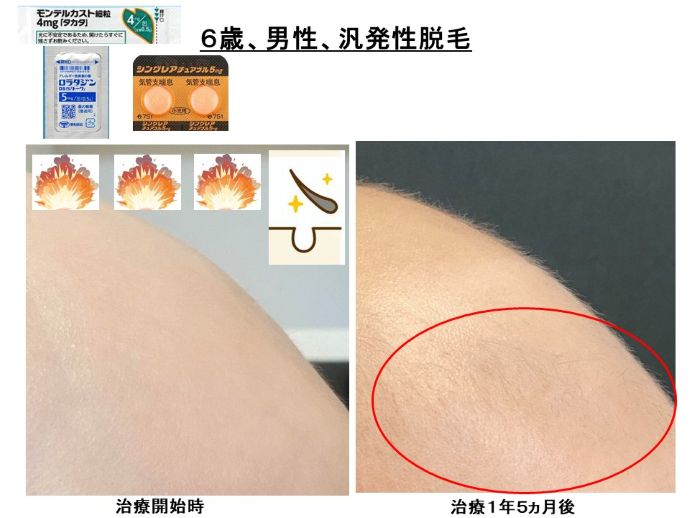 円形脱毛症　病院